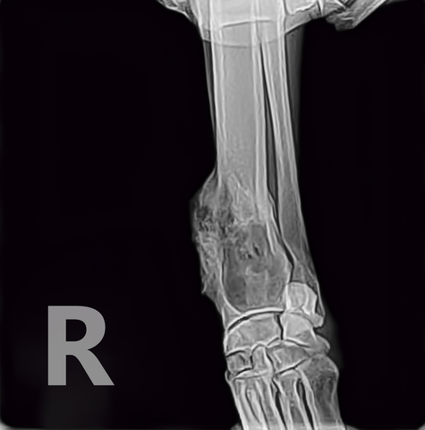 xray of osteosarcoma tumor