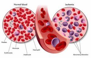 Normal blood vs. blood with leukemia